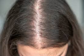 Best Ayurvedic Doctor for Hair Loss in Ravet
