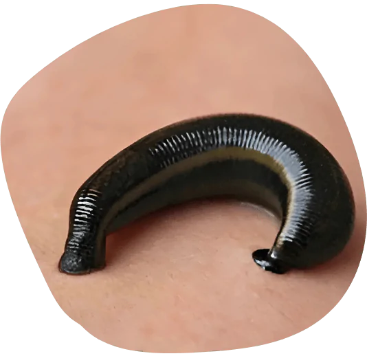 Raktmoshan leech Theraphy