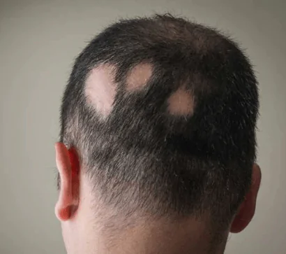Alopecia Areata