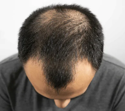 Androgenic Alopecia