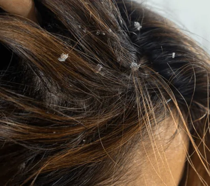 Dandruff Scalp Psoriasis